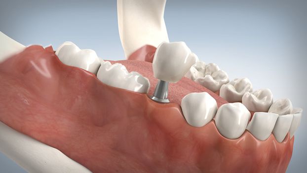 3D-Implantatplanung